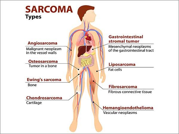 Sarcomas