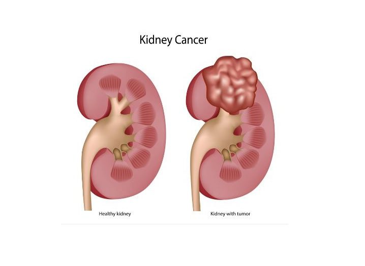 Kidney-Cancer